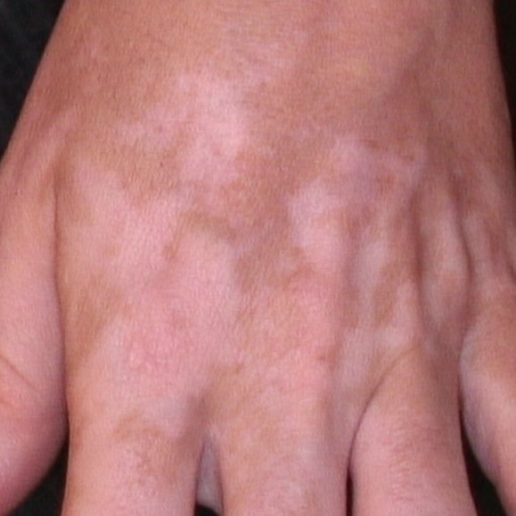 Association de la carboxythérapie avec l'ultraviolet B à bande étroite dans le traitement des zones récalcitrantes du vitiligo : un essai clinique randomisé