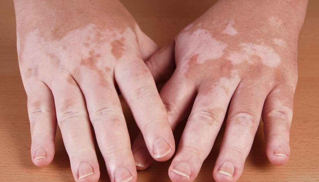 Les résultats de cette revue systématique et de cette méta-analyse suggèrent que la photothérapie UV est un traitement sûr du vitiligo sans risque significatif de cancer de la peau.
